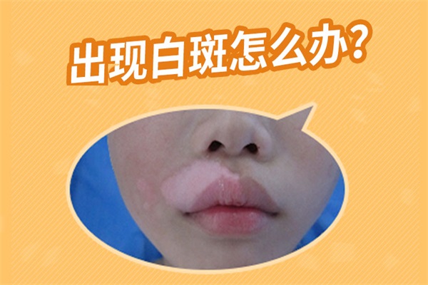 青少年患白癜風怎么辦、白癜風患者怎么治療